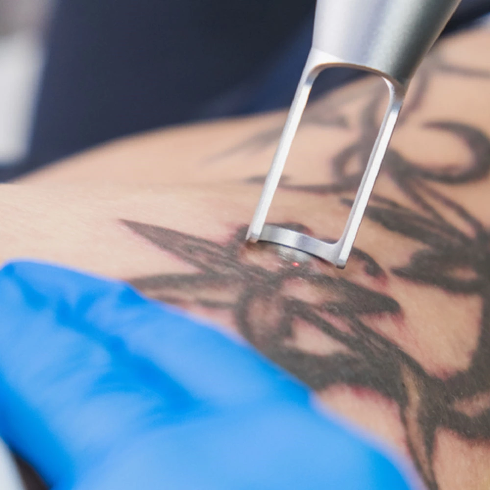 Tattoo Removal: Options and Results