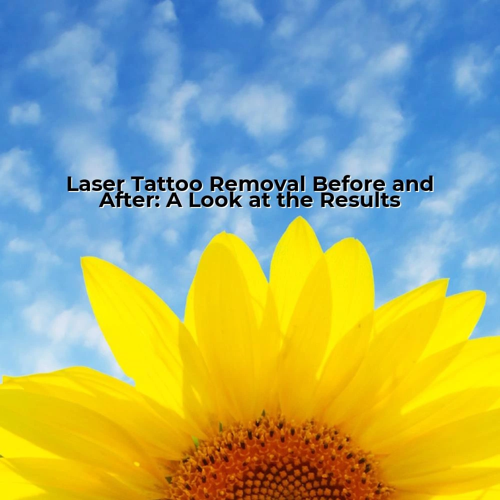 Laser Tattoo Removal Before and After